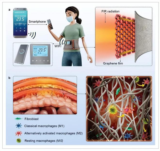 FB体育 FB体育平台华中科技大学：柔性石墨烯复合薄膜——术后腹膜粘连的预防(图1)